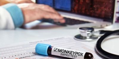 Exame laboratorial confirma segundo caso de varíola dos macacos no RS
