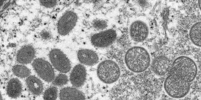 RS tem dois casos confirmados e seis suspeitos de varíola dos macacos