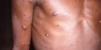 Secretaria da Saúde confirma 12 casos da varíola dos macacos no RS