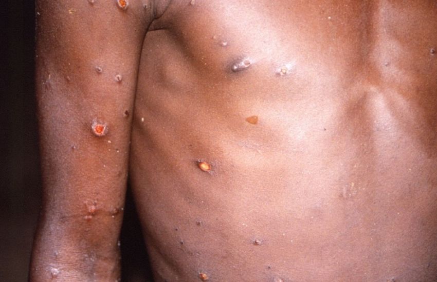 Secretaria da Saúde confirma 12 casos da varíola dos macacos no RS 