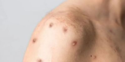 Brasil registra 88 casos de Mpox em 2026; saiba como evitar a doença